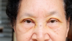 BLEDA KOŽA IUMOR NISU SAMO SIMPTOMI ANEMIJE Moguće je da vam ovaj vitamin nedostaje, jedna grupa je u posebnom riziku!