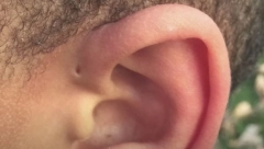 ZNATE LI ŠTA ZNAČI RUPICA NA UVETU? Prava je retkost, uopšte ne bi treblo da se nalazi na tom mestu, postoji stručno objašnjenje