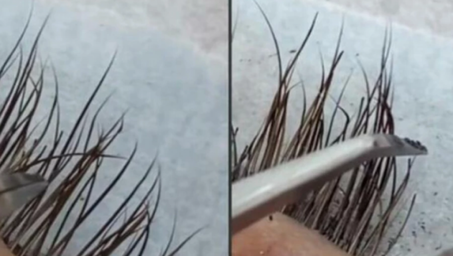 UMALO DA OSTANEM BEZ VIDA Nakon što je stavila veštačke trepavice, osetila je jeziv bol u očima! (UZNEMIRUJUĆE FOTOGRAFIJE)