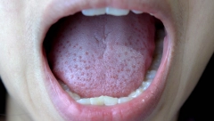 POGLEDAJTE PAŽLJIVO Ako imate ove promene na jeziku odmah se obratite lekaru, mogu biti znak ozbiljnih zdravstvenih problema