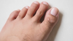 NOKTI NA NOGAMA OTKRIVAJU BOLEST Dve promene su ključne i ukazuju na tihog ubicu