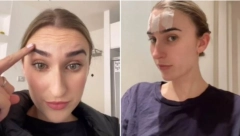 SEDAM DANA JE SPAVALA SA SELOTEJPOM NA ČELU Rezultat je neverovatan, hirurg otkriva da li stvarno ima efekta