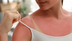 IZGORELA SAM NA SUNCU, SVEKRVIN TRIK ME SPASIO Fora je u jednom proizvodu koji svi imamo kod kuće, a nije kiselo mleko