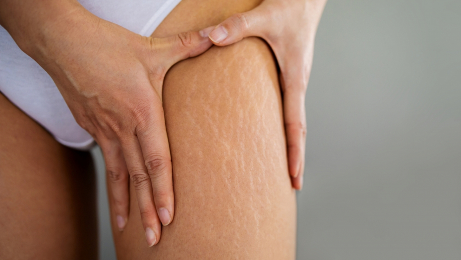 Prirodno rešenje: Kombinacija ovih ulja je efikasna u borbi protiv belih strija