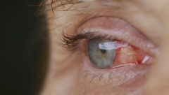 IZAZIVA POVRAĆANJE, JAKO KRVARENJE IZ NOSA I POPUCALE KAPILARE U OČIMA U ovom delu Evrope pojavio se opasan virus CCHF