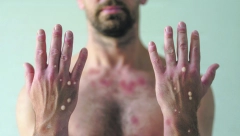 MALERČINA GODINE! Italijan fasovao majmunske boginje, koronu i HIV