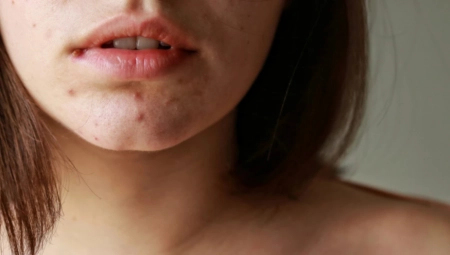 KAKO SE OSLOBODITI BUBULJICA ZA JEDNU NOĆ? Najbolji saveti dermatologa