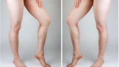 AKO VIDITE OVE PROMENE NA TELU PROVERITE ŠEĆER Prve simptome dijabetesa ljudi obično ne primete ili misle da je drugi problem u pitanju