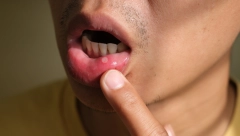 PIO JE PO ŠEST LIMENKI DNEVNO: Zbog izuzetno opasnog pića koje Srbi koriste umesto kafe, momak je pokazao da mu je jezik u živim ranama (FOTO)