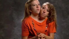 NAJREĐI OBLIK SIJAMSKIH BLIZNAKINJA: Kad su rođene rekli su da neće preživeti noć, imaju dva srca, tri bubrega, četiri plućna krila