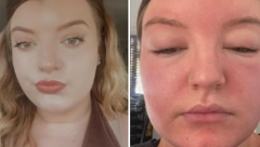 NIJE OBRAĆALA PAŽNJU NA SIMPTOME, PA SUTRADAN NIJE MOGLA OČI DA OTVORI Devojka pokazala posledice greške koju mnogi prave na suncu!