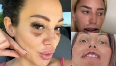 ZBOG LEPOTE UMALO IZGUBILE GLAVU Ovo su poznate dame koje su otišle pod nož i rešile se silikona, a jedna jedva preživela