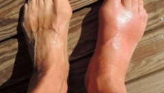 KAD BUBREZI NE RADE DOBRO Ovo su najefikasniji lekovi za uklanjanje mokraćne kiseline iz tela