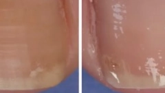 POŽUTELI SU VAM NOKTI NA NOGAMA Namažite ih smesom od dva jeftina sastojka i vratiće prirodnu boju