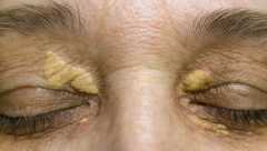 AKO PRIMETITE OVU PROMENU NA KAPCIMA, ODMAH SE JAVITE LEKARU: Koža pokazuje da li patite od ove ozbiljne bolesti