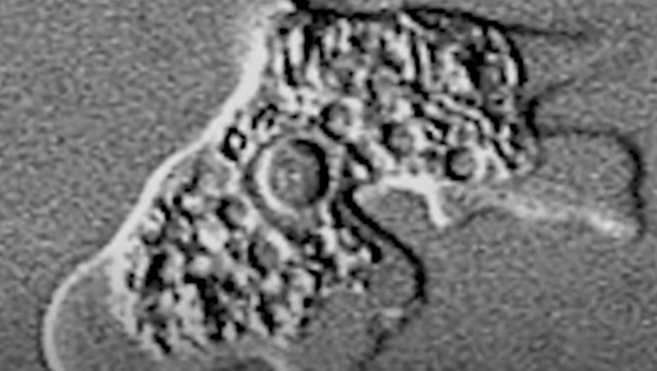 "AMEBA KOJA JEDE MOZAK" ODNELA MLAD ŽIVOT: Drugi fatalan slučaj u ovoj državi