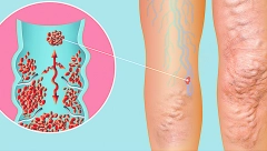 AKO OVO PRIMETITE, ODMAH IDITE DO LEKARA! Krvni ugrušci mogu biti smrtonosni, a postoje znaci upozorenja!