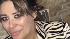 ŠTA SE DESILO SA NJENIM LICEM? Isplivale jezive fotografije Ane Nikolić, PEVAČICA SVA U OŽLJCIMA