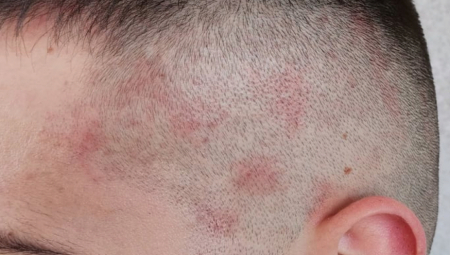 ERMIN SE TUŠIRAO TRI PUTA DNEVNI I EVO ŠTA SE DESILO SA NJEGOVOM KOŽOM: Danas trećinu plate troši na kreme i lekove