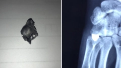 OBJAVLJEN RENDGENSKI SNIMAK Ovo je metak koji je izvađen iz šake srpskog mladića (FOTO)