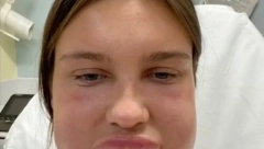 OD REAKCIJE JOJ JE OTEKLA CELA GLAVA Otišla je na kozmetički tretman, a završila u bolnici, ovo svaka žena treba da zna