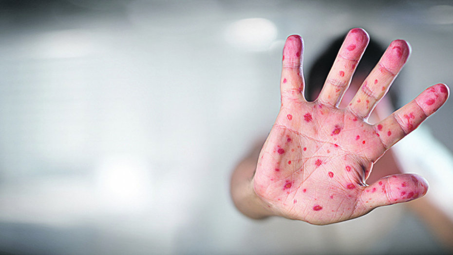 RASTE BROJ ZARAŽENIH BiH preti epidemija