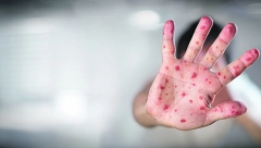 "VIRUS MALIH BOGINJA JE PRISUTAN I CIRKULIŠE" Doktori upozoravaju posle novih slučajeva: Svaki oboleli može da zarazi 15 ljudi