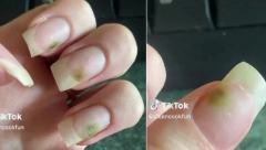 ŽENE BUDITE OPREZNE Devojka podelila kako izgleda kada nokti postanu žrtvom lošeg manikira