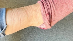 DA LI VAM SE NA KOŽU OCRTAVA UDUBLJENJE OD ČARAPA? Moguće da je znak bolesti, dobro proverite o čemu se radi