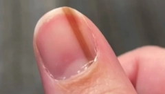 MARIJA JE GODINAMA VEROVALA DA JE LINIJA NA NOKTU NJEN ZAŠTITNI ZNAK Iza svega se krila jeziva istina, da nije bilo jednog doktora više ne bila živa