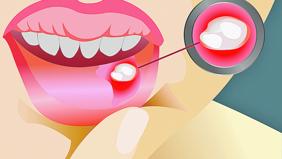 Svaki peti čovek na planeti muku muči s ranicama po ustima jer ne znaju ovaj jednostavni lek za afte