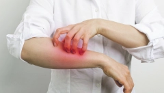 PROMENE SU KAO BUBULJICE I UJED KOMARCA Zašto se šuga pojavljuje u vrtićima i školama otkriva pedijatar