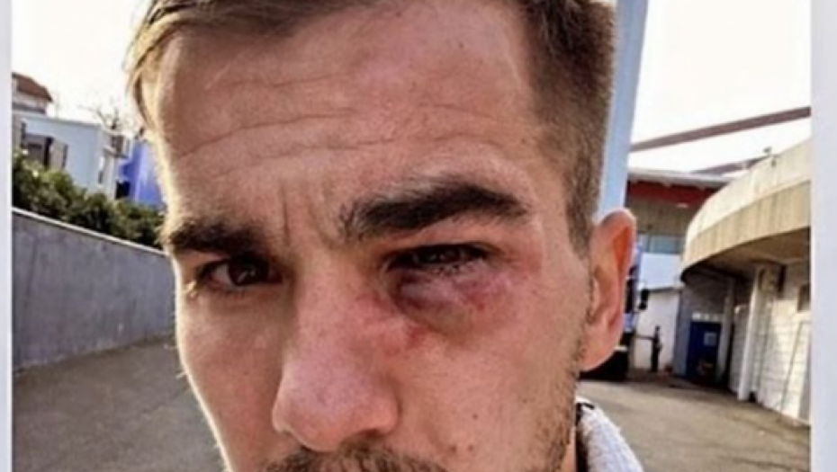 JEZIVA POVREDA Ovako izgleda lice fudbalera kad ga protivnik nagazi kopačkom (FOTO)