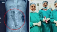 DVADESET DANA NIJE VRŠIO NUŽDU: Primljen je u bolnicu, a hirurzi su se frapirali kad su ga operisali(FOTO)