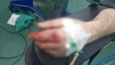 UZNEMIRUJUĆE FOTOGRAFIJE UPUCANOG SRBINA U ZVEČANU Stanje ranjenog Galjaka zabrinjavajuće, povrede jezive