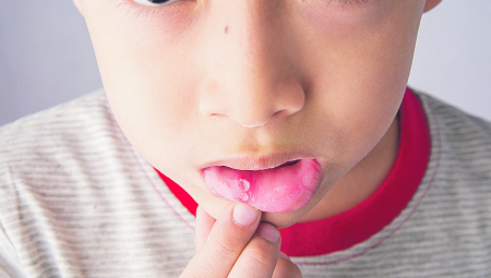 BOLNE RANICE Pedijatar dr Aneta Jovanović govori o tome kako nastaju afte kod dece