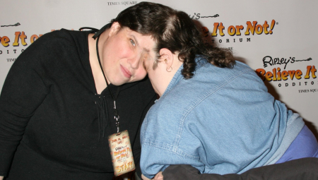 POSLEDNJI POZDRAV Preminuli najstariji sijamski blizanci na svetu, do samog kraja živeli odvojeno bez operacije