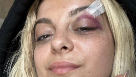 PEVAČICA ALBANSKOG POREKLA OBJAVILA FOTKU STRAVIČNIH PODLIVA! Pogođena u glavu nakon što je pokazivala dvoglavog orla, a sada se javno svima obratila! (FOTO)
