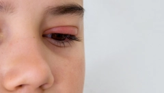 DEČAK (3) DOBIO VAŠKE NA TREPAVICAMA Doktori se zgranuli kada su videli zašto ga je oko svrbelo