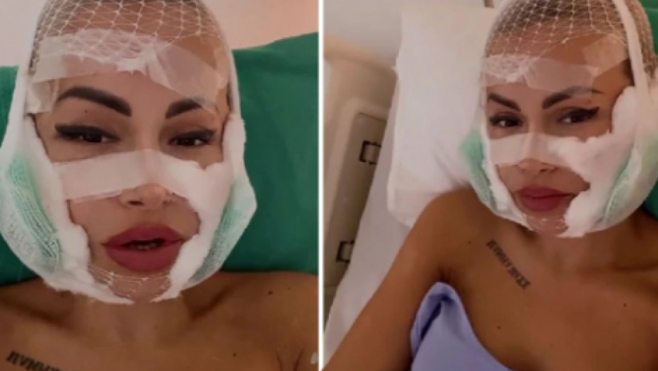 NAJNOVIJE LICE ERMINE PAŠOVIĆ Bivša zadrugarka skinula zavoje, pa se pohvalila kako izgleda pred ulazak u "Zadrugu 7"?! (FOTO)