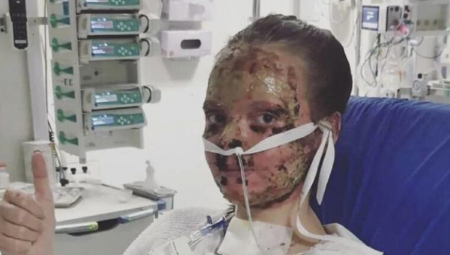 STUDENTKINJA NA SPAVANJU GORELA U PLAMENU: Pukom srećom je preživela, celo lice joj je izgorelo, a evo kako sad izgleda (FOTO)