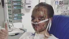 STUDENTKINJA NA SPAVANJU GORELA U PLAMENU: Pukom srećom je preživela, celo lice joj je izgorelo, a evo kako sad izgleda (FOTO)