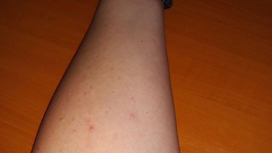 ZA ANDRIJANU SE ZAKAČILO 103 KRPELJA Berba šljiva se pretvorila u pravu agoniju (FOTO)