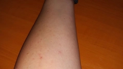ZA ANDRIJANU SE ZAKAČILO 103 KRPELJA Berba šljiva se pretvorila u pravu agoniju (FOTO)