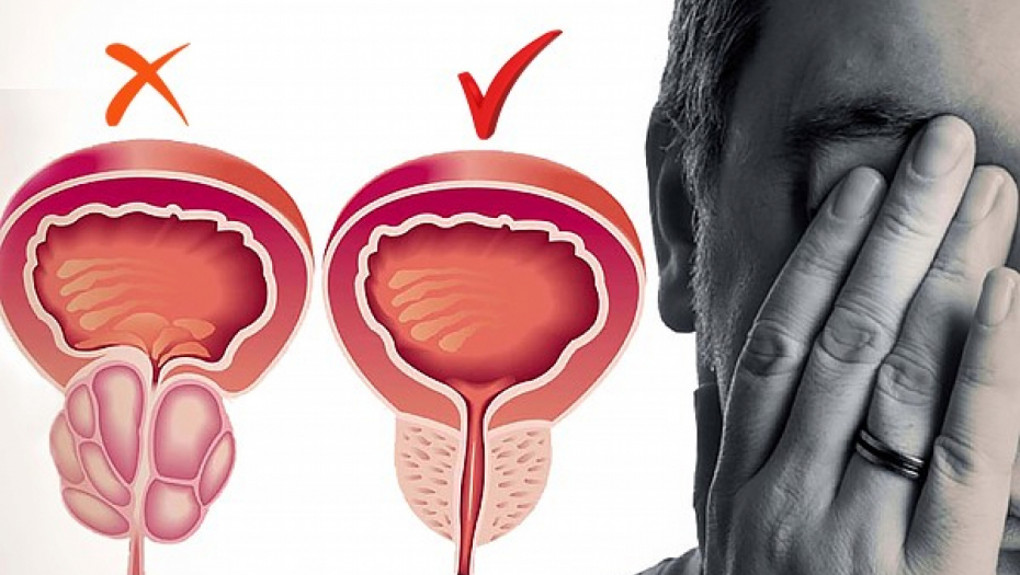 Laserska hirurgija prostate je poslednje medicinsko dostignuće u lečenju dobroćudnog uvećanja prostate
