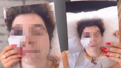 "OD UDARCA SAM PALA, VIŠE SE NIČEGA NE SEĆAM" Manijak brutalno pretukao devojku (20) iz Paraćina, izlomio je i zatvorio joj oko