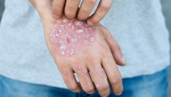 SVETSKI DAN BORBE PROTIV PSORIJAZE Kožno oboljenje koje ima i Kim Kardašijan, ne leči se, ali se može značajno ublažiti