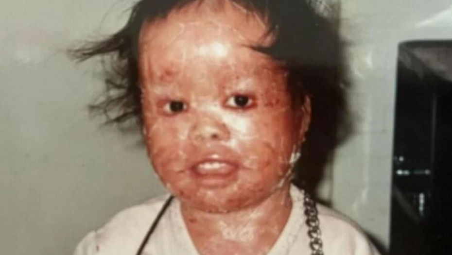 DEVOJČICU SA CRVENOM KOŽOM NIKO NIJE HTEO DA USVOJI Živela je u mukama, pa izrasla u šampiona