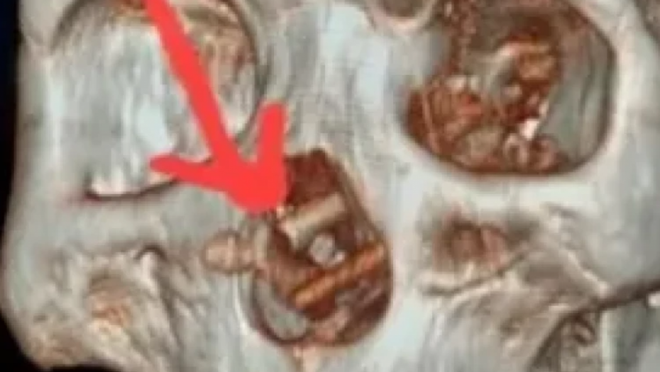 KAKO JE OVO MOGUĆE? Čovek primljen u bolnicu zbog glavobolja, kada su lekari pronašli ovo u njegovom nosu zanemeli su