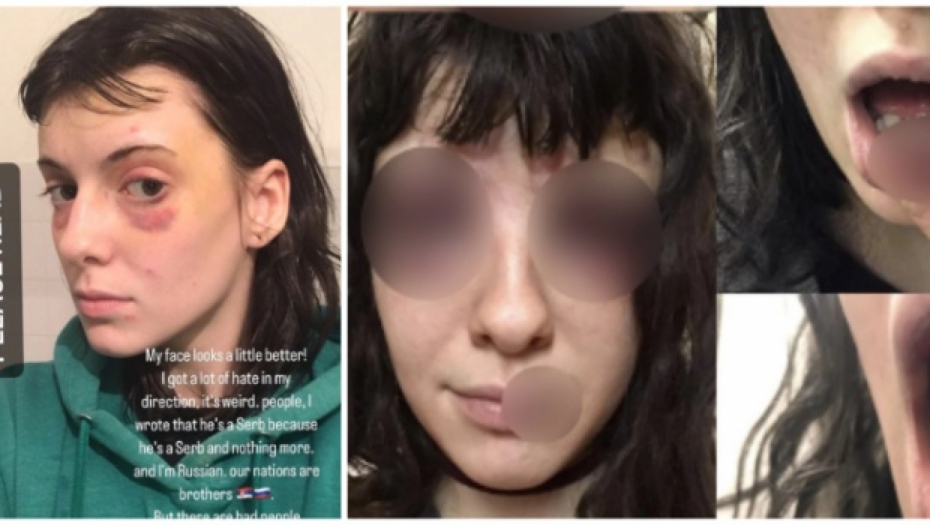 "LEŽALA SAM NA PODU I MOLILA GA DA PRESTANE DA ME BIJE" Jeziva ispovest Ruskinje (19) koju je pretukao dečko iz Srbije